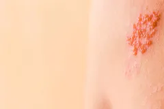 Herpes zóster: el riesgo silencioso que aumenta en personas con enfermedades crónicas